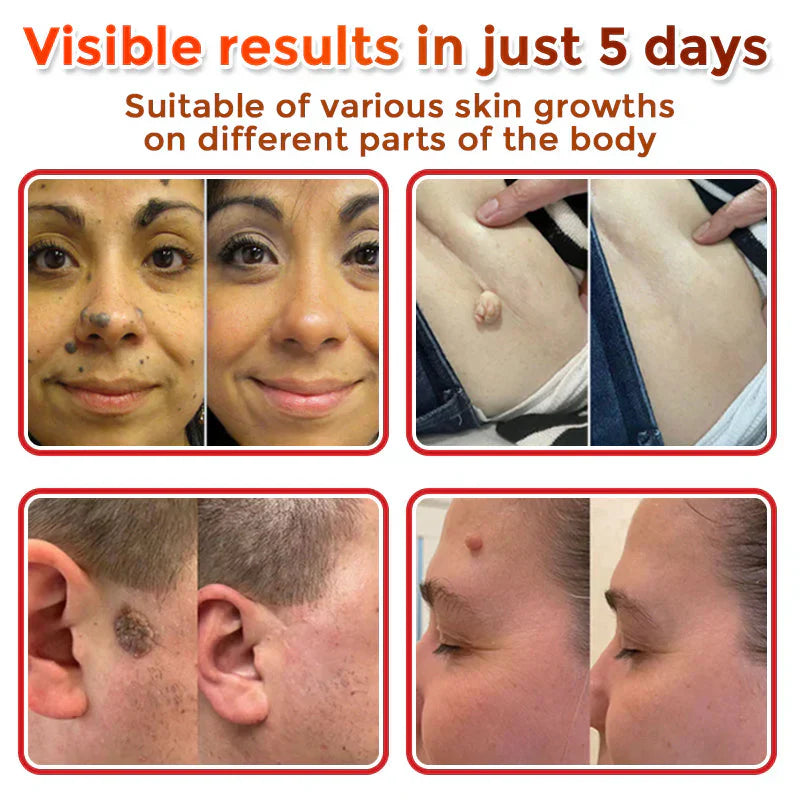 🌈LOVILDS® MicroNeedle Botanic Skin Tag Removal Patch (Made in the USA)