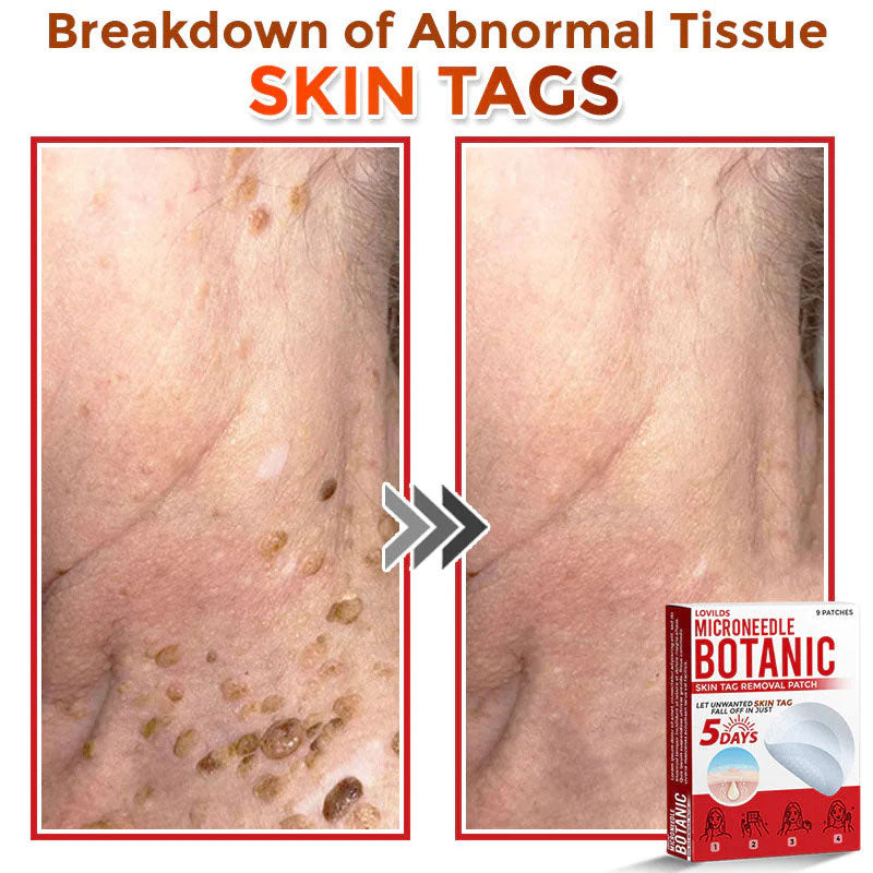 🌈LOVILDS® MicroNeedle Botanic Skin Tag Removal Patch (Made in the USA)