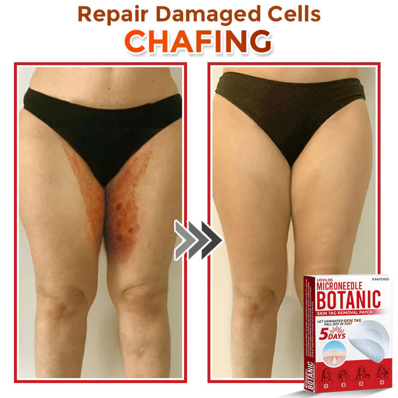 🌈LOVILDS® MicroNeedle Botanic Skin Tag Removal Patch (Made in the USA)