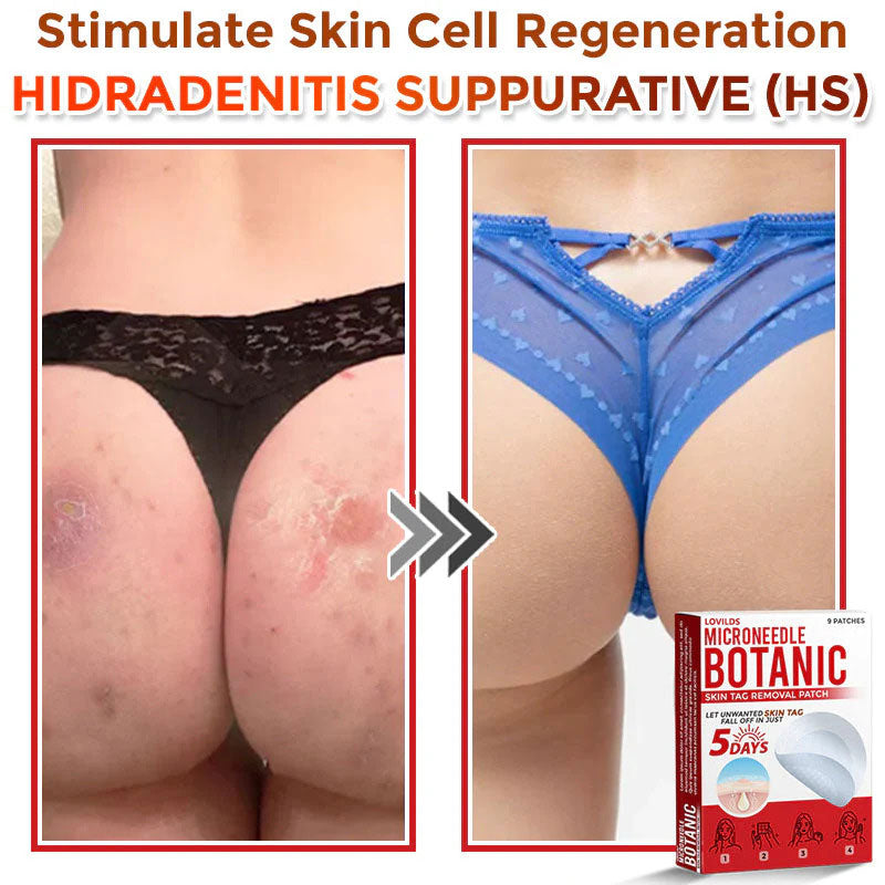 🌈LOVILDS® MicroNeedle Botanic Skin Tag Removal Patch (Made in the USA)